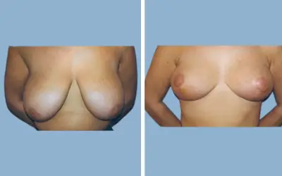 Before and After